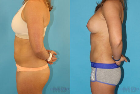 Liposuction case #5883