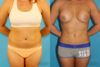 Liposuction case #5883 slider thumbnail