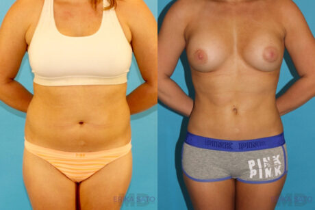 Liposuction case #5883