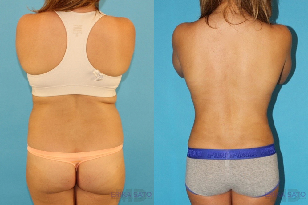 Liposuction case #5883