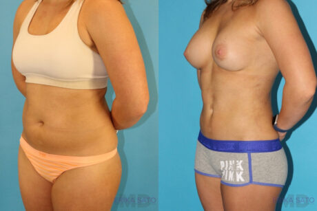 Liposuction case #5883