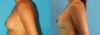 Revision Breast Surgery case #256254 slider thumbnail