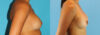 Revision Breast Surgery case #256254 slider thumbnail