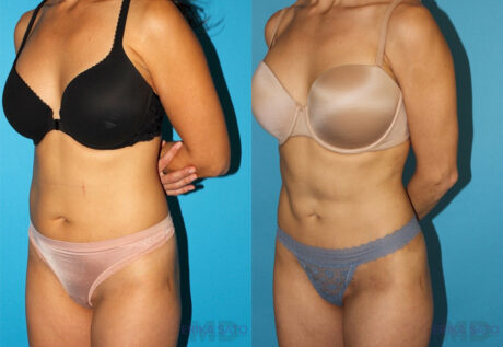 Liposuction case #5839