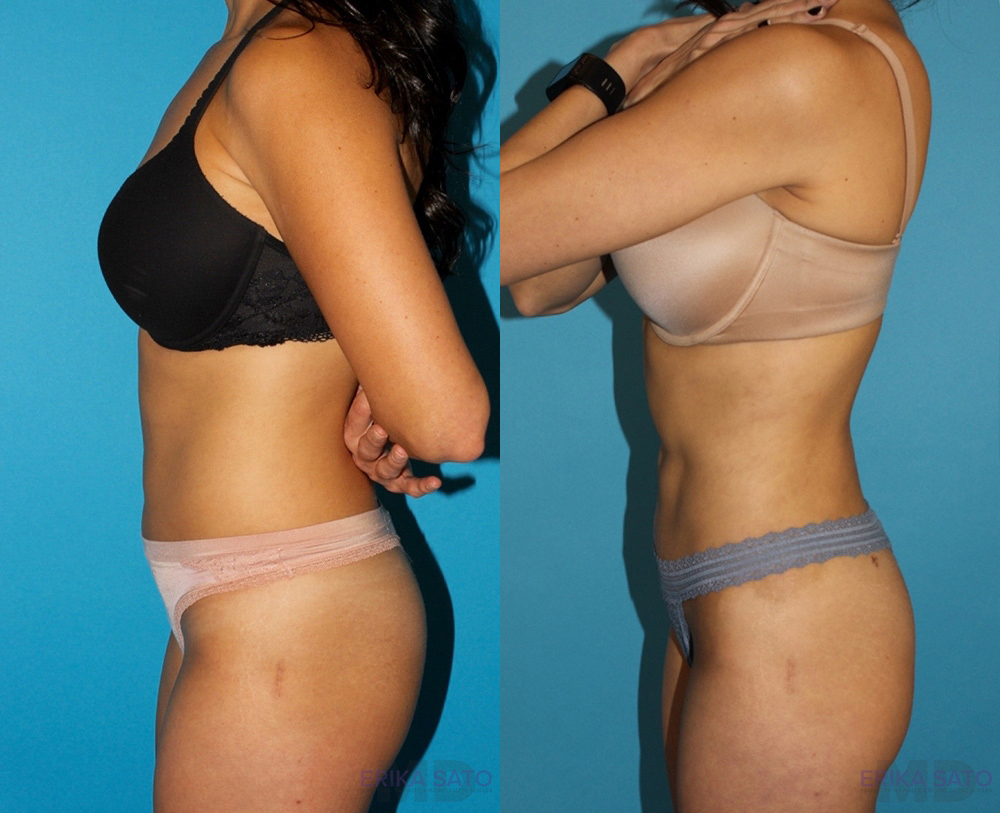 Liposuction case #5839
