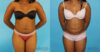 Liposuction case #5838 slider thumbnail