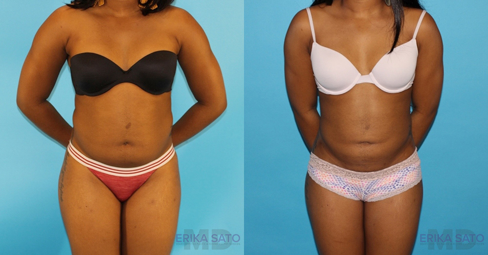 Liposuction case #5838