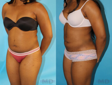 Liposuction case #5838