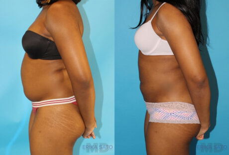 Liposuction case #5838