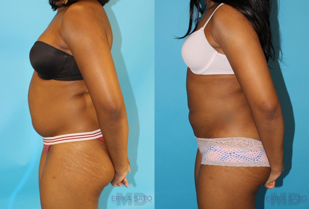 Liposuction case #5838