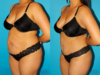Tummy Tuck case #7276 slider thumbnail