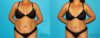 Tummy Tuck case #7276 slider thumbnail