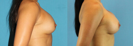 Revision Breast Surgery case #256248