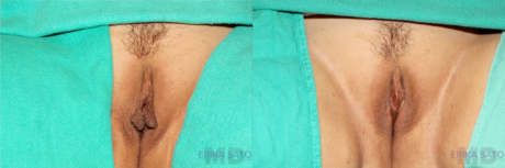 Labiaplasty case #5753