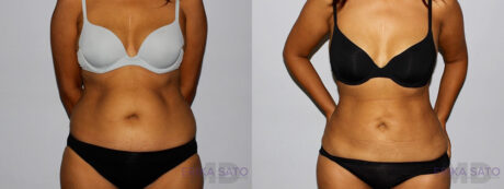 Liposuction case #5835