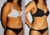 Liposuction case #5835 slider thumbnail