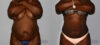 Liposuction case #5834 slider thumbnail