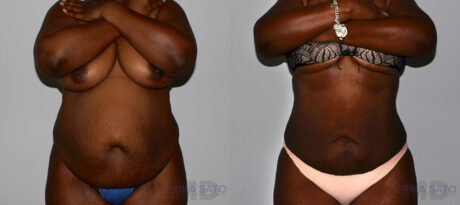 Liposuction case #5834