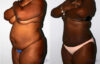 Liposuction case #5834 slider thumbnail