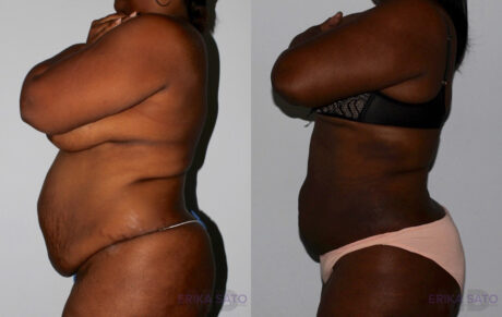 Liposuction case #5834