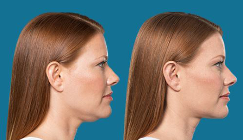 Procedure case #5591