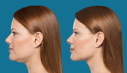 Procedure case #5591