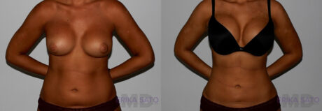 Liposuction case #5833