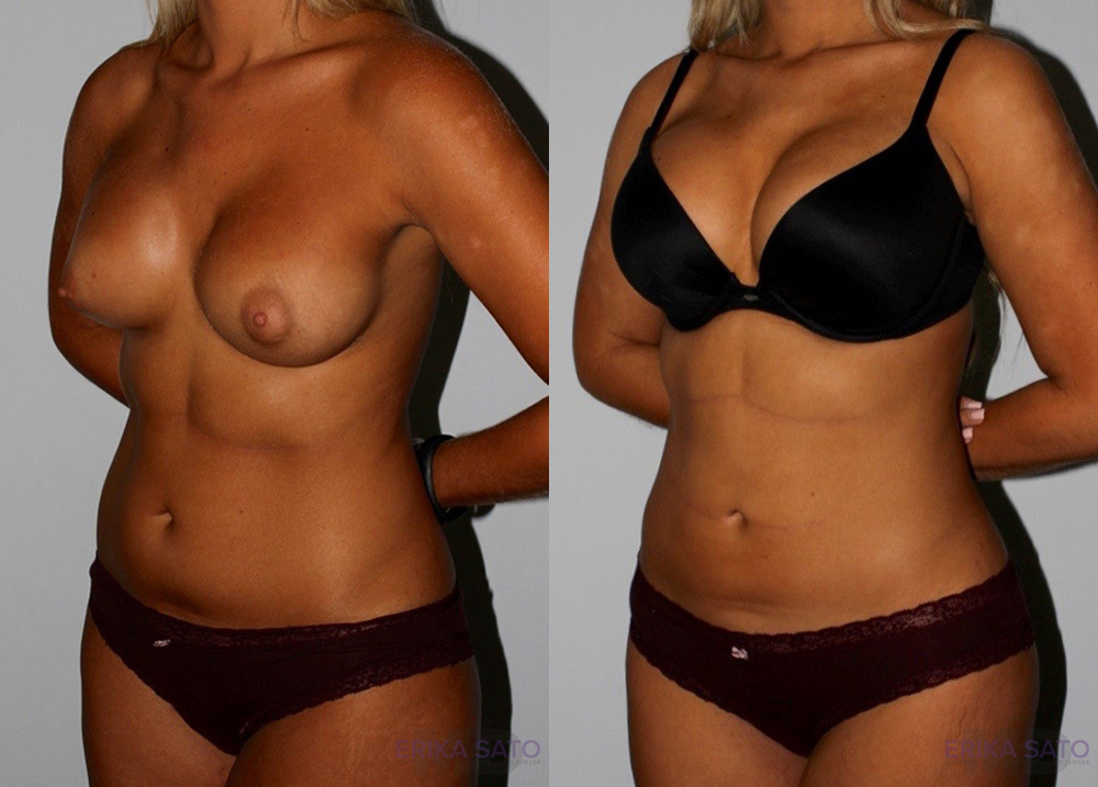Liposuction case #5833