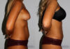 Liposuction case #5833 slider thumbnail