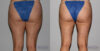 Liposuction case #5832 slider thumbnail