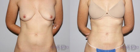 Liposuction case #5831