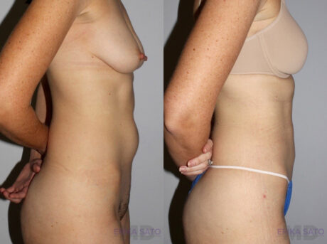 Liposuction case #5831