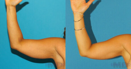 Liposuction case #5960