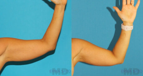 Liposuction case #5960