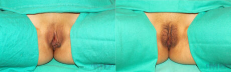 Labiaplasty case #5752