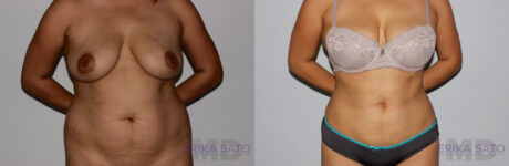 Liposuction case #5830