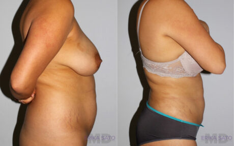 Liposuction case #5830