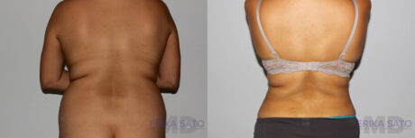 Liposuction case #5830