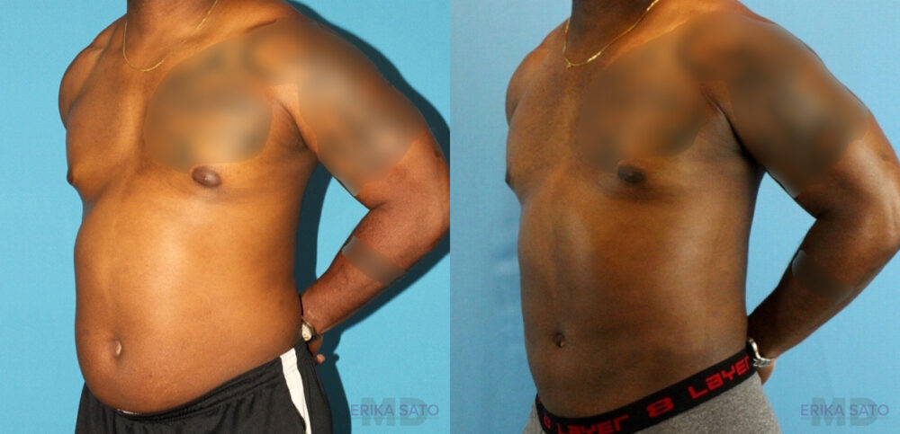 Liposuction case #5966