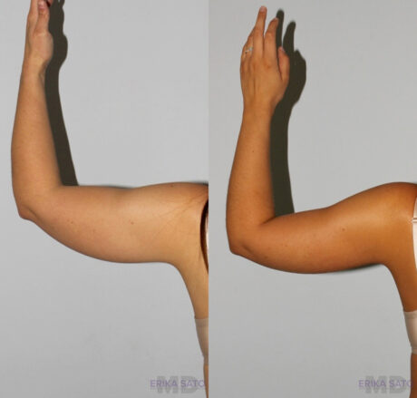 Liposuction case #5827