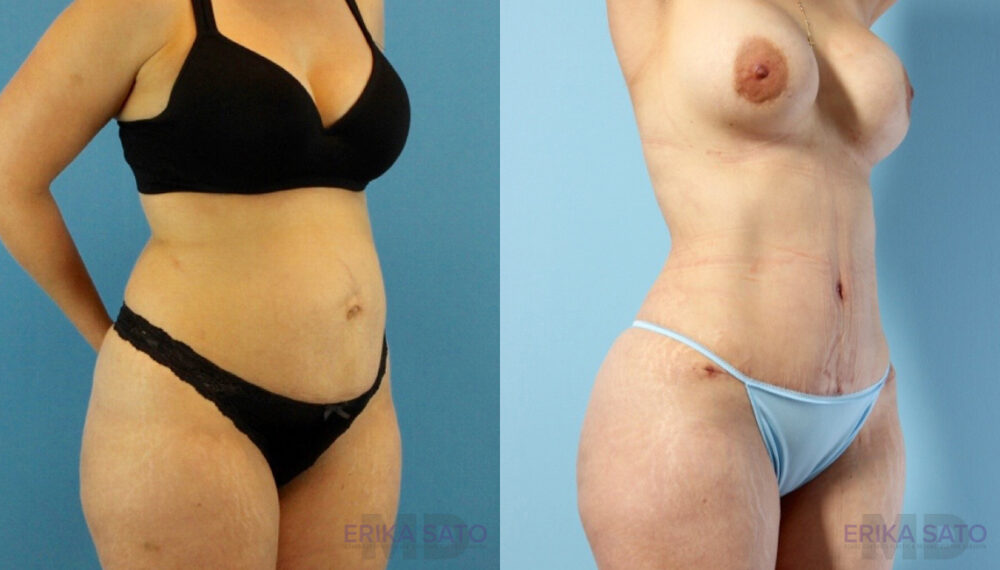 Tummy Tuck case #263490