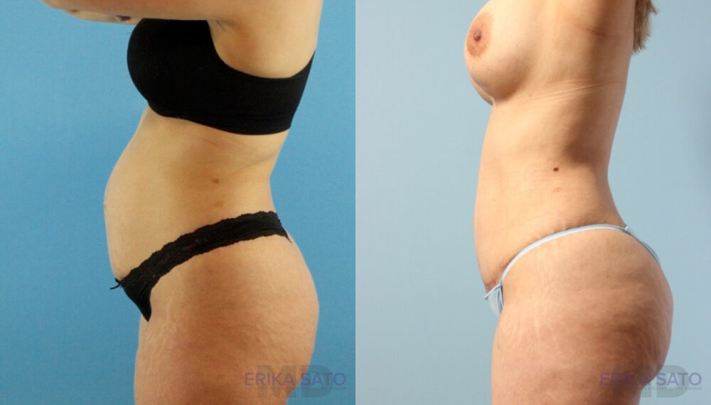Tummy Tuck case #263490