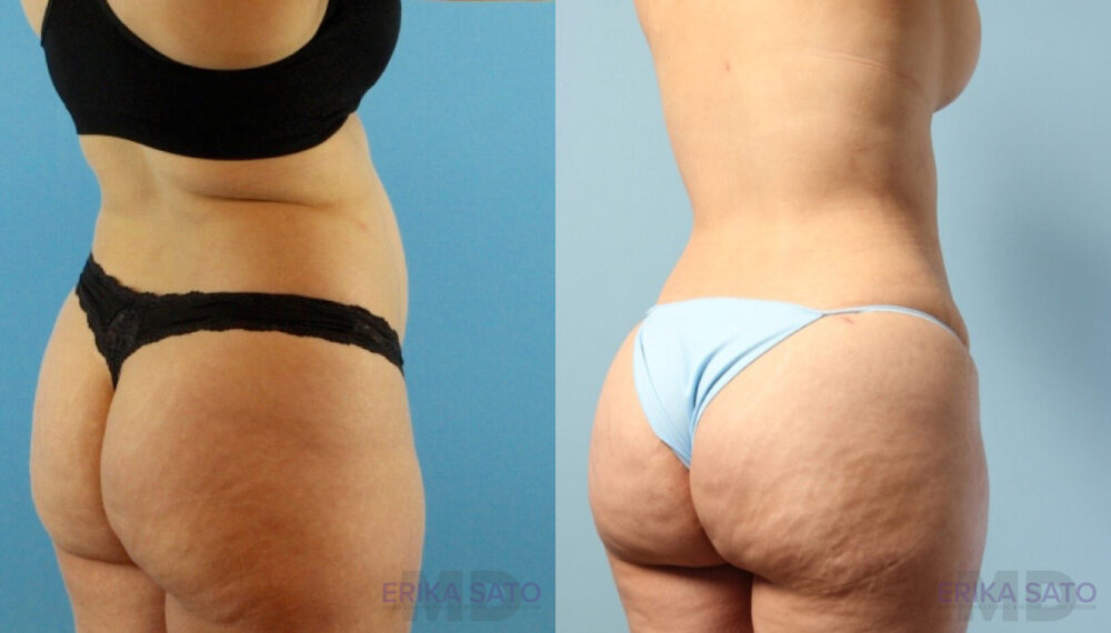 Tummy Tuck case #263490