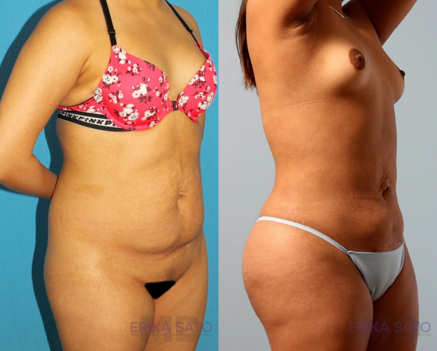 Brazilian Butt Lift case #4823