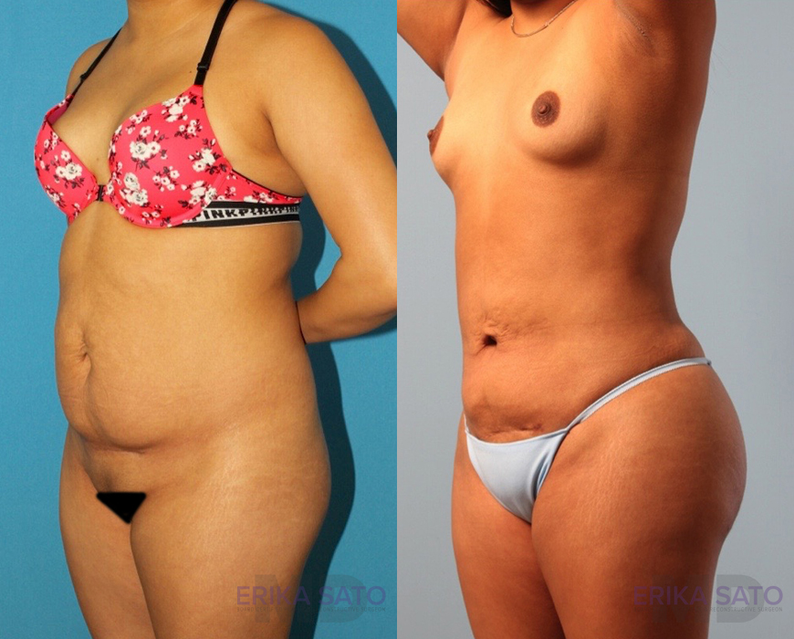 Brazilian Butt Lift case #4823