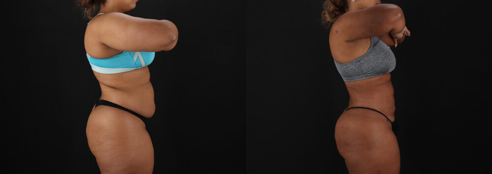 Brazilian Butt Lift case #5513