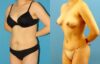 Tummy Tuck case #7343 slider thumbnail