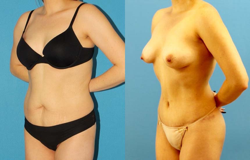 Tummy Tuck case #7343