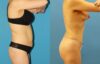 Tummy Tuck case #7343 slider thumbnail