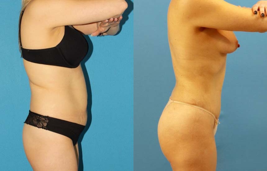 Tummy Tuck case #7343